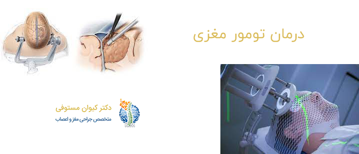 درمان تومور مغزی