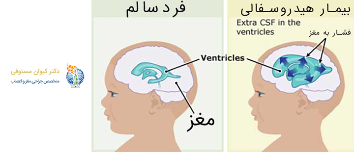 هیدروسفالی چیست؟
