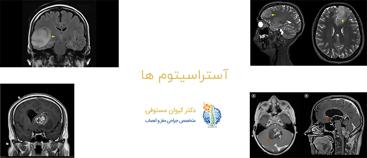 آستراسیتوم ها 