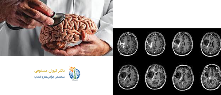 آسیب شناسی تومور مغزی