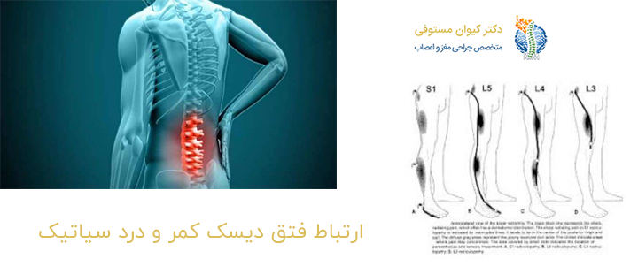 ارتباط فتق دیسک کمر و درد سیاتیک