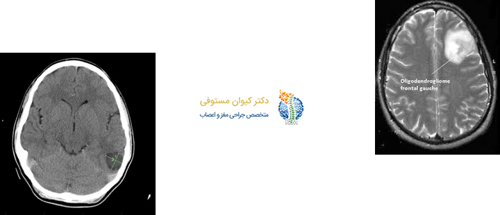  الیگودندروگلیوم چیست؟
