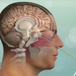 انواع جراحی قاعده جمجمه