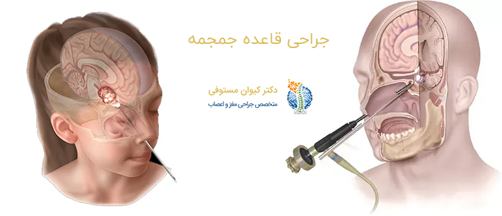 جراحی قاعده جمجمه چیست؟