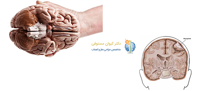 درباره تومور مننژیوم مغزی
