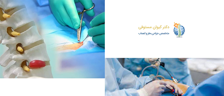 درباره جراحی کم تهاجمی ستون فقرات