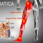 فتق دیسک کمر و درد سیاتیک چه ارتباطی دارند؟