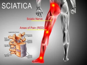 فتق دیسک کمر و درد سیاتیک چه ارتباطی دارند؟