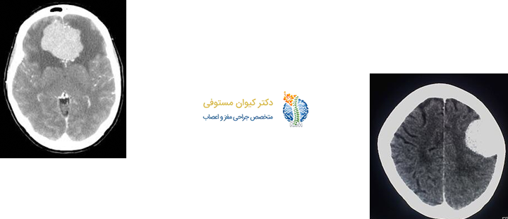 مننژیوم چیست؟
