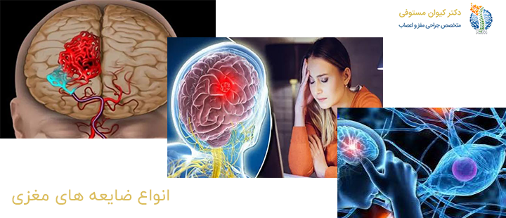 آشنایی با انواع ضایعه های مغزی