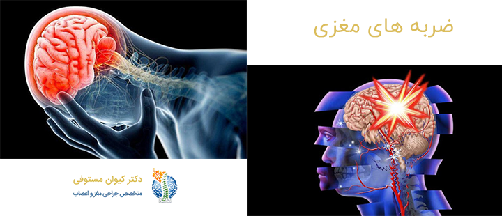 درباره ضربه های مغزی
