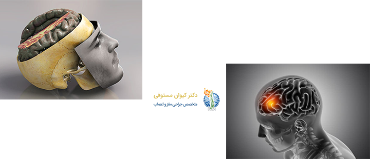 ضربه مغزی چیست؟