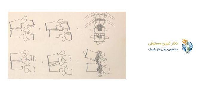 آسیب نخاعی و ستون مهره ها 