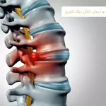 تشخیص و درمان کانال تنگ کمری