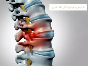 تشخیص و درمان کانال تنگ کمری