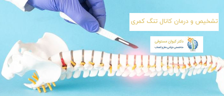 تشخیص و درمان کانال تنگ کمری به چه صورت است؟