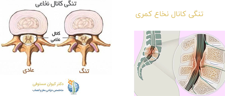 تنگی کانال نخاع کمری
