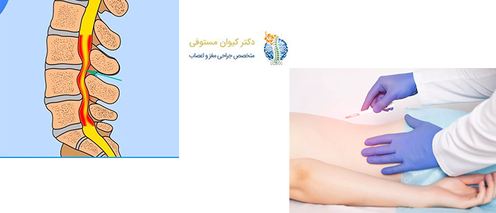 درباره تشخیص و درمان تنگی کانال نخاع کمری