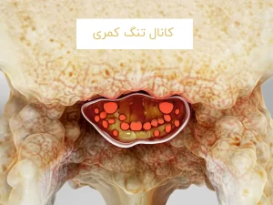 کانال تنگ کمری