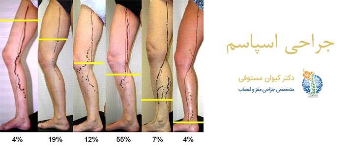 جراحی اسپاسم چگونه انجام می‌شود؟