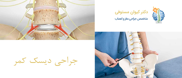 درباره جراحی دیسک کمر 