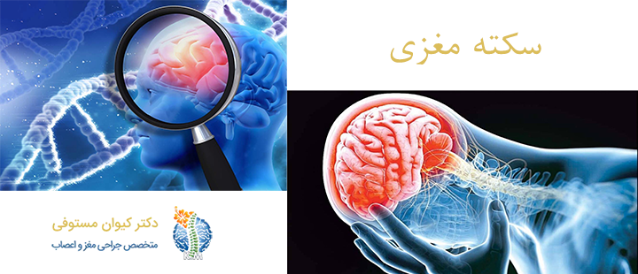 درباره سکته مغزی