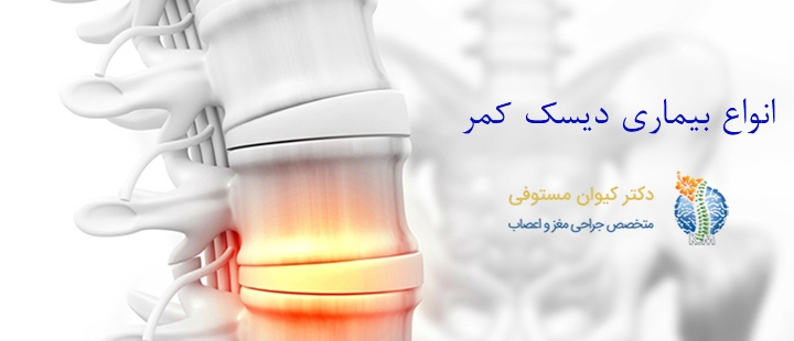 آشنایی با انواع بیماری دیسک کمر

