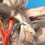 جراحی میکروسکوپی دیسک کمر چگونه انجام می‌شود؟