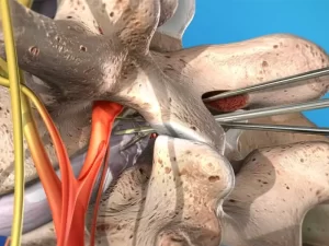 جراحی میکروسکوپی دیسک کمر چگونه انجام می‌شود؟