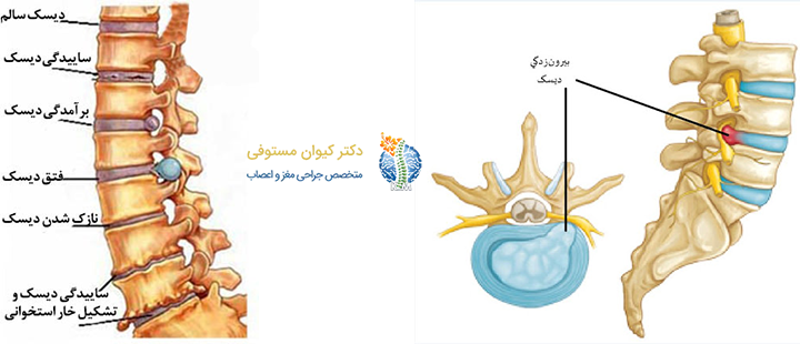 درباره انواع بیماری دیسک کمر