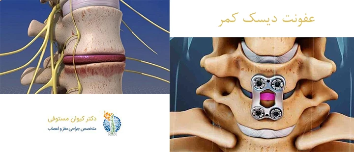درباره عفونت دیسک کمر