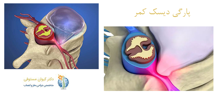 درباره پارگی دیسک کمر
