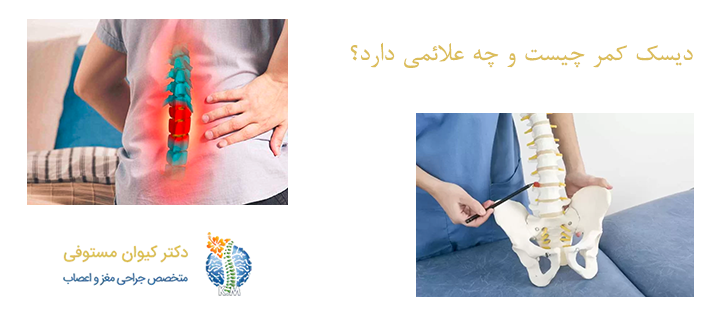 دیسک کمر چیست و چه علائمی دارد؟