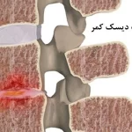 عفونت دیسک کمر