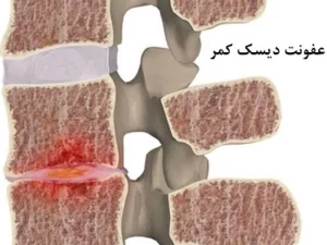 عفونت دیسک کمر