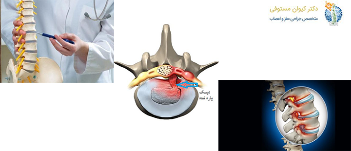 علائم پارگی دیسک کمر