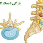 پارگی دیسک کمر