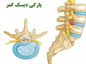 پارگی دیسک کمر