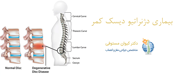 بیماری دژنراتیو دیسک کمر