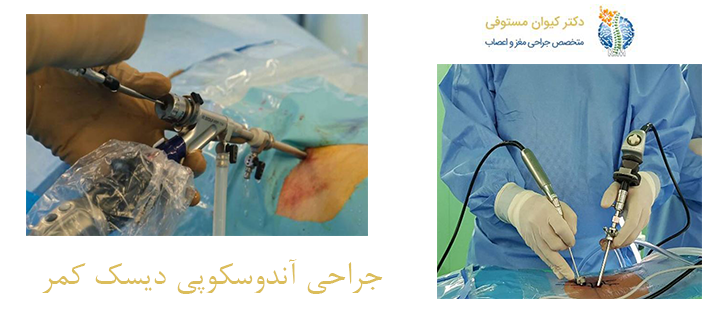 درباره جراحی آندوسکوپی دیسک کمر