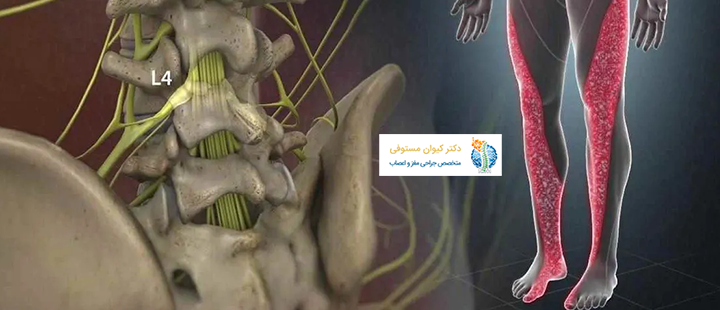 درباره علائم دیسک کمر در پاها