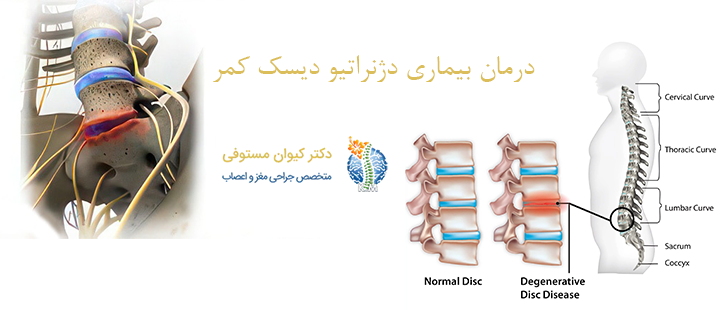 درمان بیماری دژنراتیو دیسک کمر