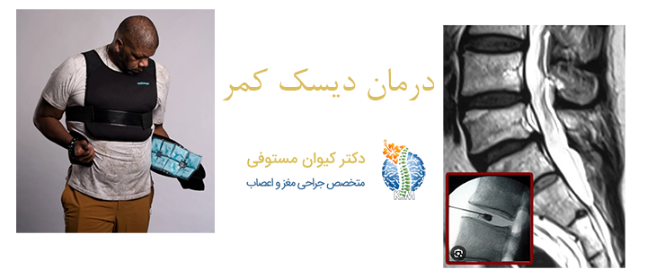 درمان دیسک کمر