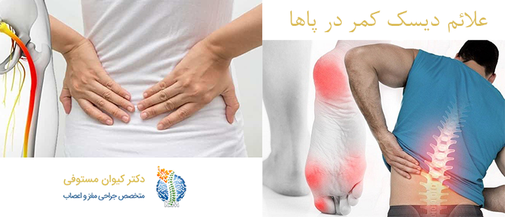 دیسک کمر در پاها چه علائمی دارد؟