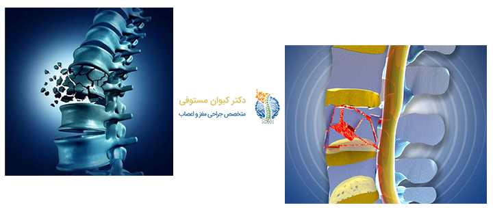 آشنایی با شکستگی ستون فقرات