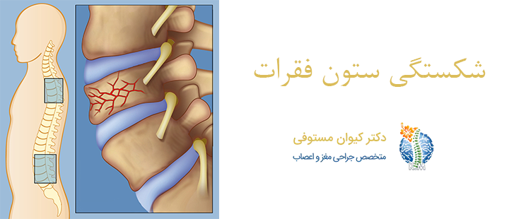 درباره شکستگی ستون فقرات 