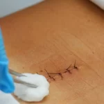 مراقبت های بعد از جراحی دیسک کمر