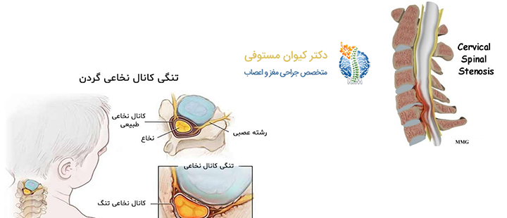 تنگی کانال نخاعی گردن و علائم آن