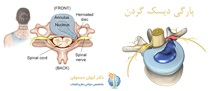 درباره پارگی دیسک گردن