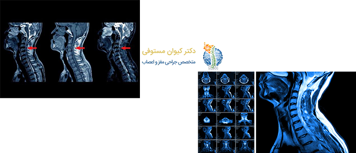 درمان دیسک گردن